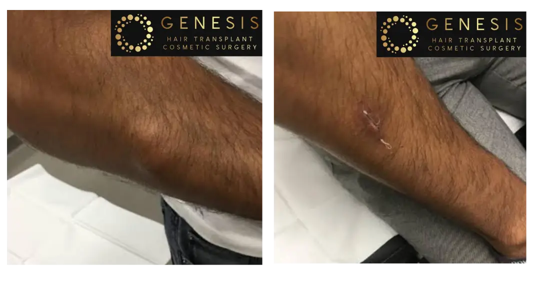 Lipoma excision