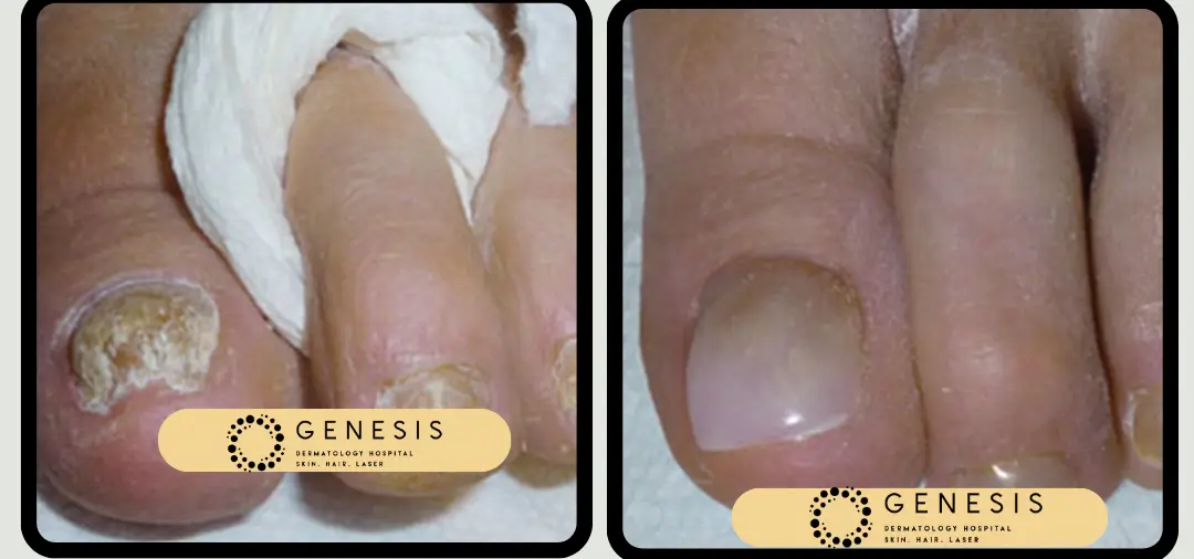 Nail repair