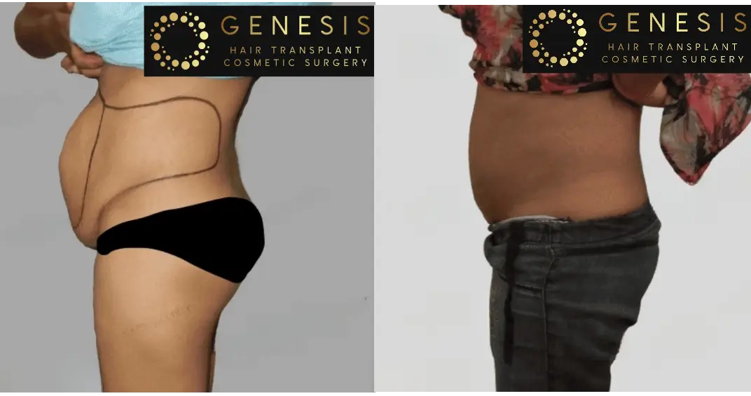 Tummy Tuck